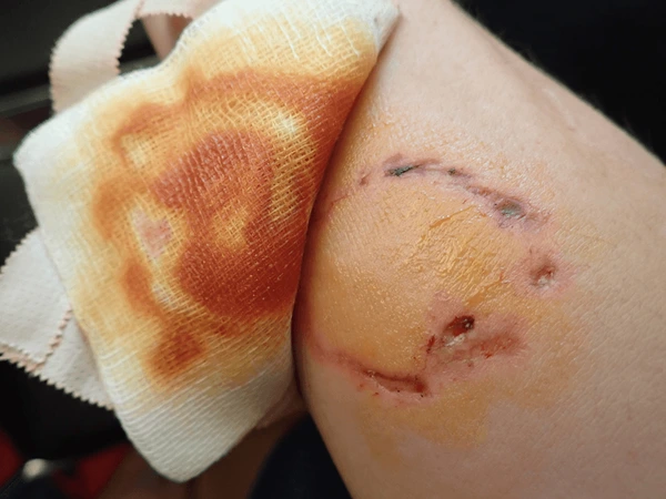 Psychological wounds